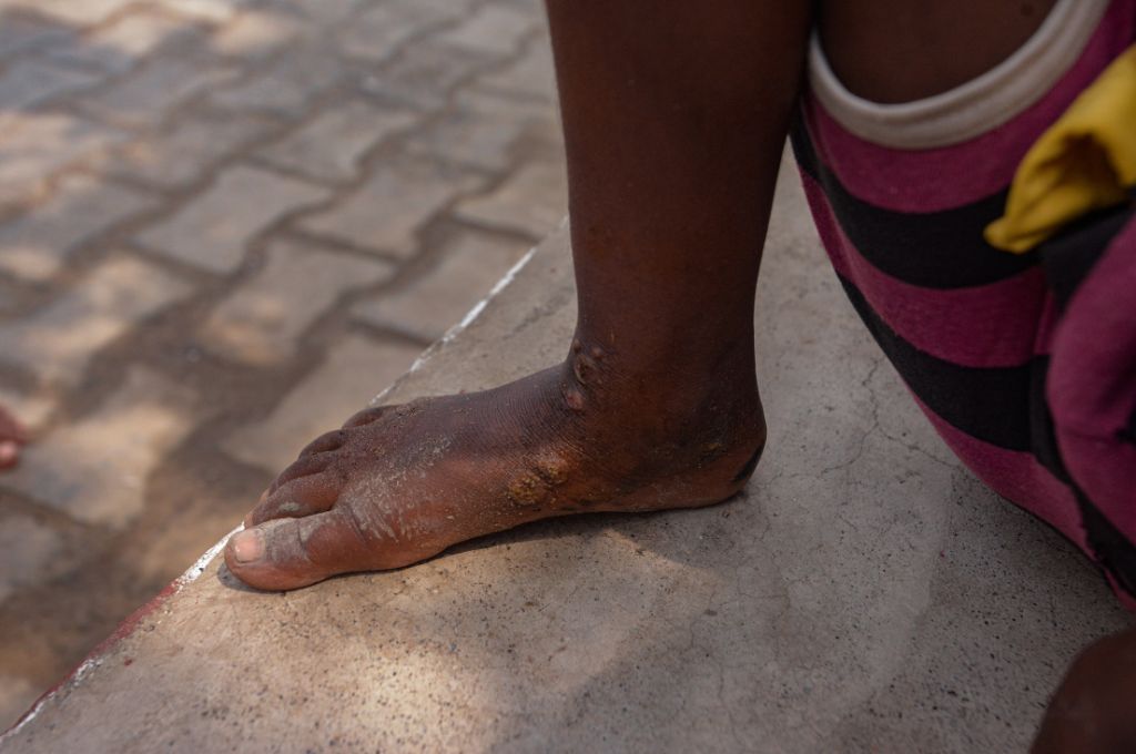 A person's feet covered in rashes. Due to their proximity to the ETPS ash pond, most of the kids who play outdoors in Seppakam village suffer from skin allergies_industrialisation